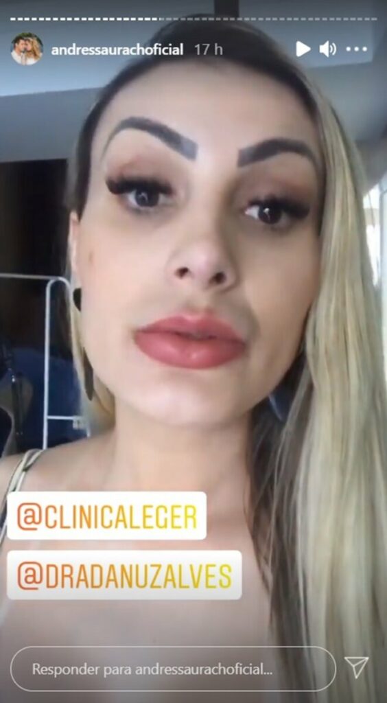 Andressa Urach Coloca Mais Preenchimento Labial E Mostra Resultado Parcial Para Os F S Boca